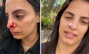 לינוי אשרם תקיפה כלב (צילום: מתוך האינסטגרם של לינוי)