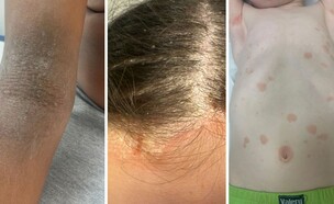 תופעות העור שמתפשטות בקרב ילדים