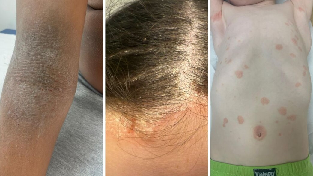 תופעות העור שמתפשטות בקרב ילדים