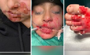 כוויות חמורות (צילום: פרטי)