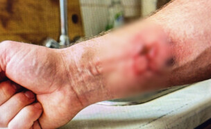 דקרה את בנה באמצעות מזלג