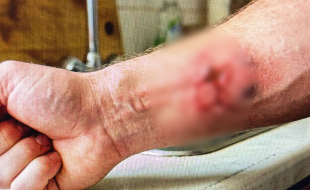 דקרה את בנה באמצעות מזלג