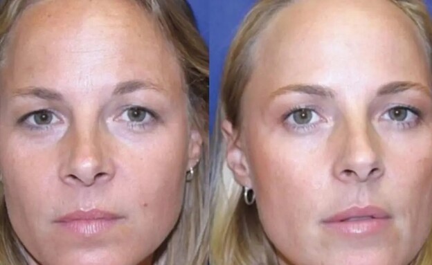 מחקר הבוטוקס (צילום: American Medical Association)