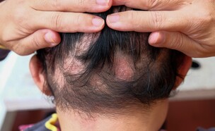 קרחות אילוסטרציה (צילום: shutterstock_Tikkyshop)