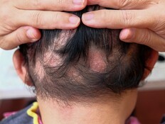 קרחות אילוסטרציה (צילום: shutterstock_Tikkyshop)