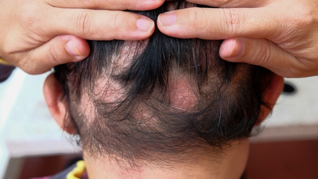 קרחות אילוסטרציה