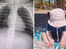 החופשה המשפחתית הסתיימה בטיסה דחופה - וניתוח חירום