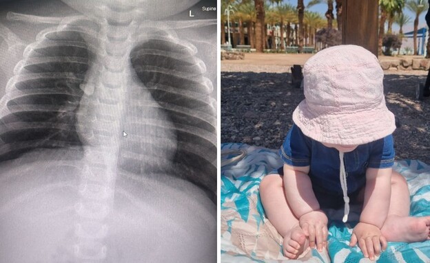 תינוקת שאפה אבן (צילום: שניידר)