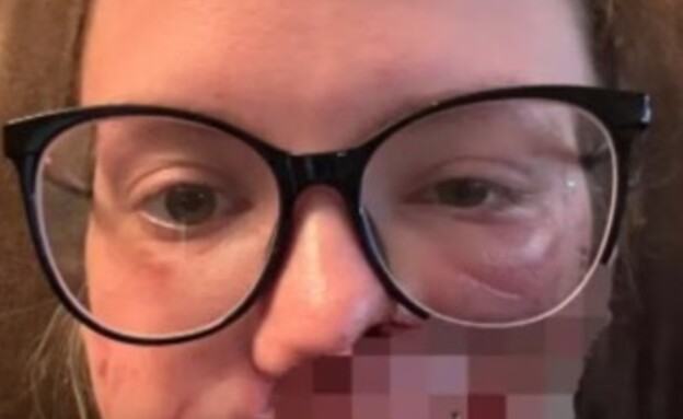 האישה שננשכה