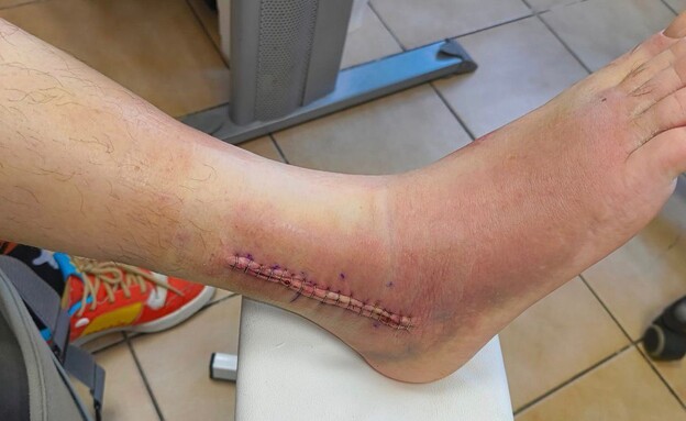 שבר את הקרסול