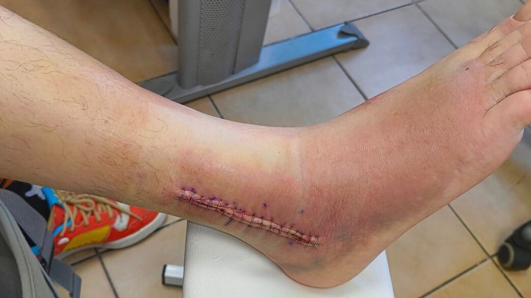 שבר את הקרסול