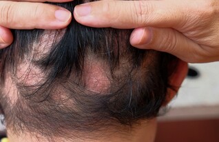 קרחות אילוסטרציה (צילום: shutterstock_Tikkyshop)