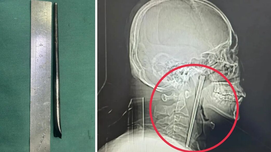 סין: גבר חי שמונה שנים עם צ'ופסטיק תקוע בגרון