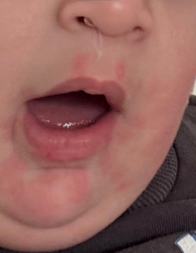 אלרגיה לביצים