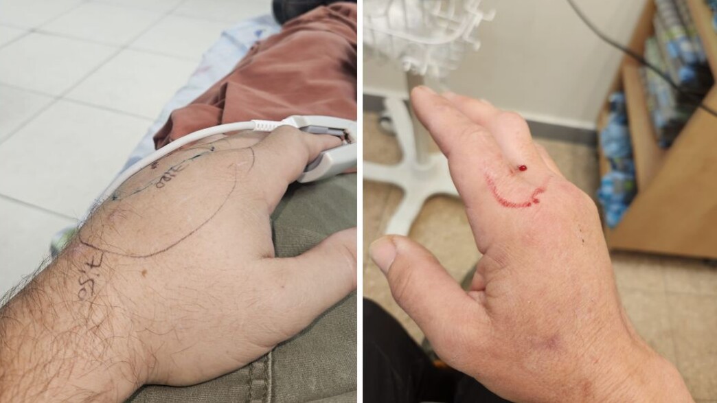 עונת הנחשים החלה: כ-250 ישראלים מוכשים מדי שנה