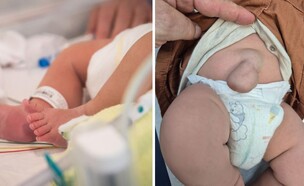 בקע טבורי (צילום: getty images, ד״ר ארתור בעזוב)