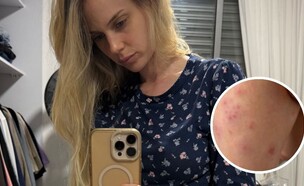 בר זומר: "עוברת תקופה שלא נגמרת. שלבקת חוגרת היא תוצאה של הנפש" (צילום: barzomer, instagram)