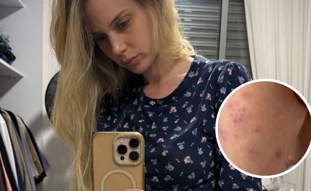 בר זומר: "עוברת תקופה שלא נגמרת. שלבקת חוגרת היא תוצאה של הנפש" (צילום: barzomer, instagram)