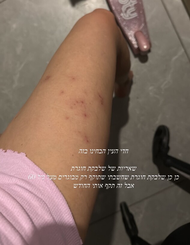 בר זומר: "עוברת תקופה שלא נגמרת. שלבקת חוגרת היא תוצאה של הנפש"