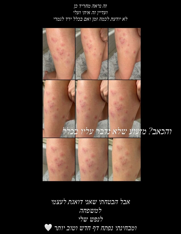 בר זומר: "עוברת תקופה שלא נגמרת. שלבקת חוגרת היא תוצאה של הנפש"