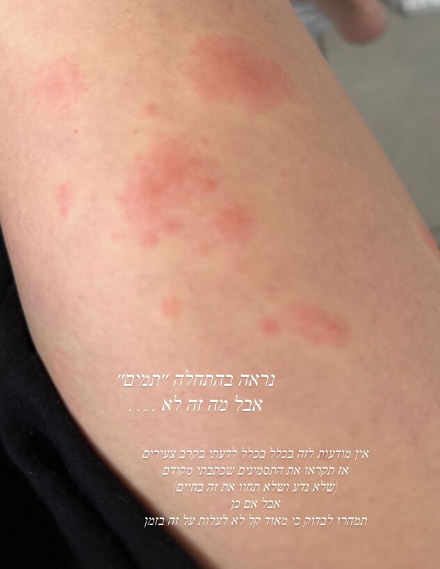 בר זומר: "עוברת תקופה שלא נגמרת. שלבקת חוגרת היא תוצאה של הנפש"