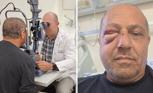 שבר בארובת העין (צילום: הלל יפה)