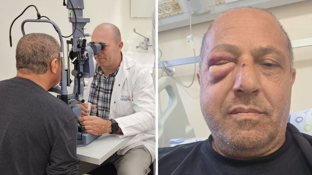שבר בארובת העין שבר בארובת העין