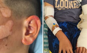 ילד נפצע לאחר פיצוץ מיכל דאורדורנט בל"ג בעומר (צילום: בית חולים מאיר)