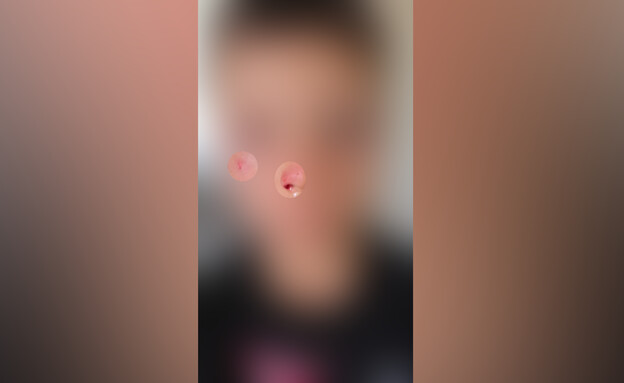 הילד שהוכה ע"י ילדים אחרים בצהרון בקריית ביאליק הילד שהוכה ע"י ילדים אחרים בצהרון בקריית ביאליק
