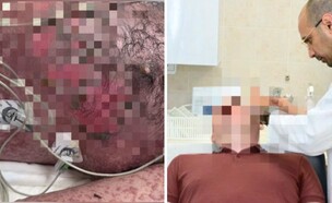 אלרגיה נדירה (צילום: לגליל)