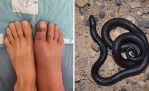 הוכש ע"י שרף עין גדי  (צילום: הדסה עין כרם)