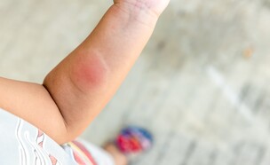 פעוט נעקץ מעקיצת יתוש (צילום: shutterstock)
