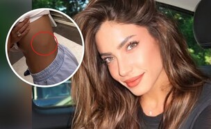 דניאל גרינברג פציעה בצלעות  (צילום: instagram, פרטי)