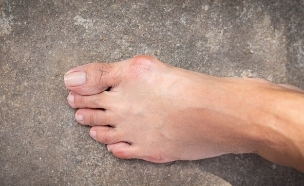 בוהן קלובה (צילום: shutterstock_pemastockpic)