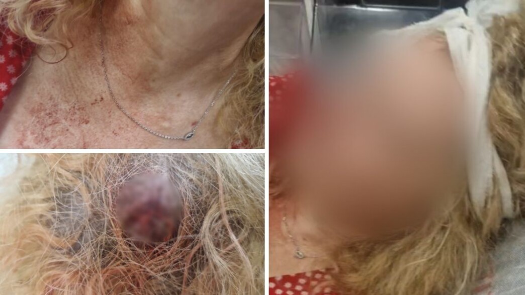 תושבת חדרה שהותקפה תושבת חדרה שהותקפה