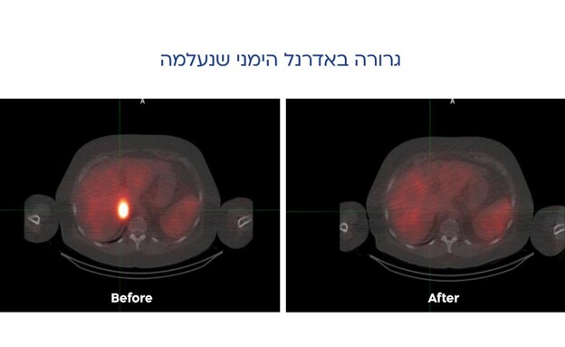 הגרורה שנעלמה הגרורה שנעלמה
