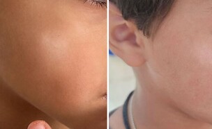 Pityriasis alba (צילום: באדיבות הקריה האקדמית אונו)