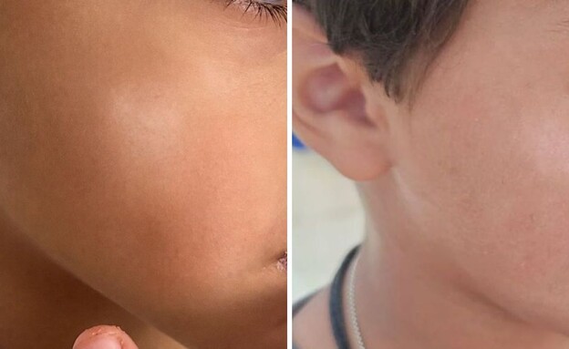 Pityriasis alba