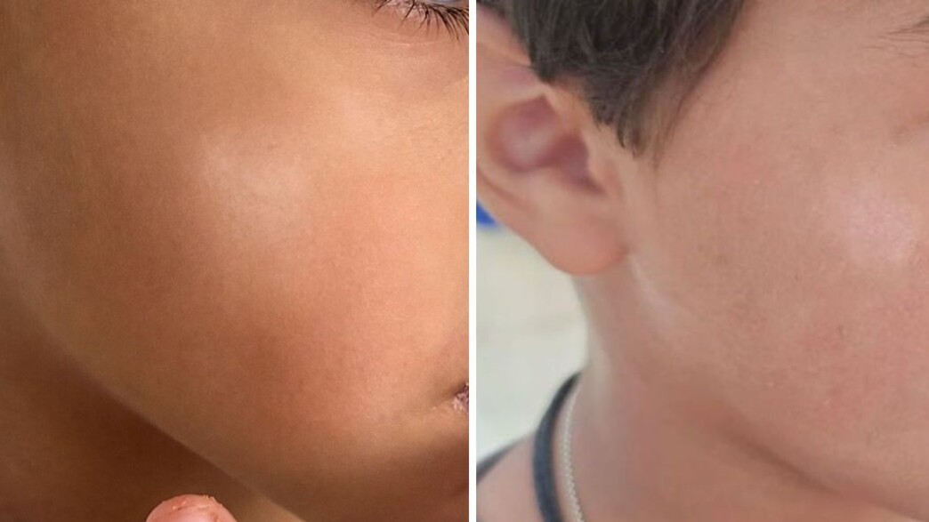 Pityriasis alba