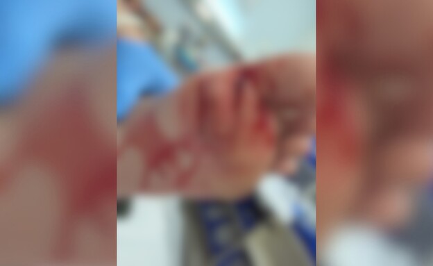 בת 10 ננשכה בכף רגלה על ידי דג מורנה בת 10 ננשכה בכף רגלה על ידי דג מורנה