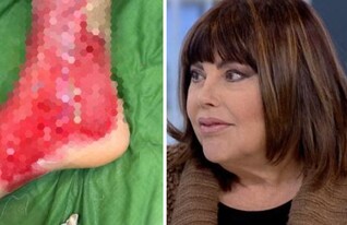 כוויות כימיות (צילום: חדשות הבוקר, שיבא)
