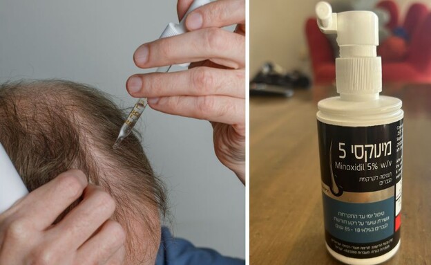 מינוקסי MINOXIDIL