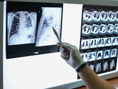 COPD אילוסטרציה
